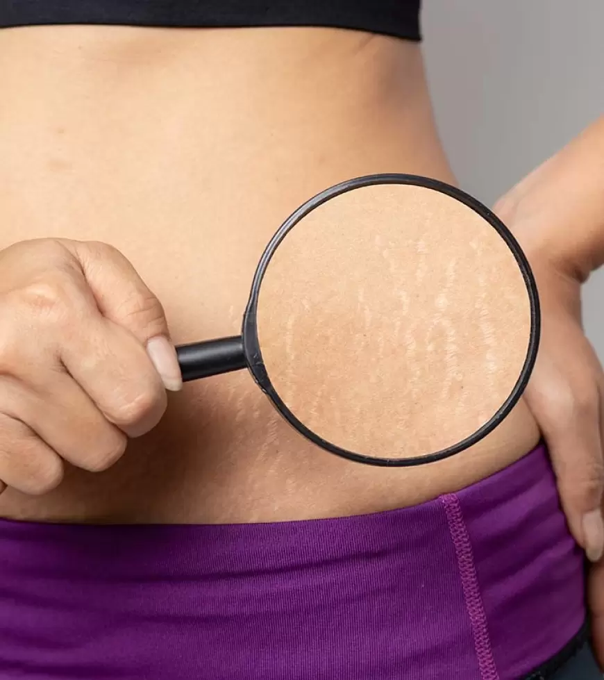 Stretch marks: गर्भावस्था के स्ट्रेच मार्क्स से पाना चाहते है छुटकारा, तो अपनाए ये 9 तरीके