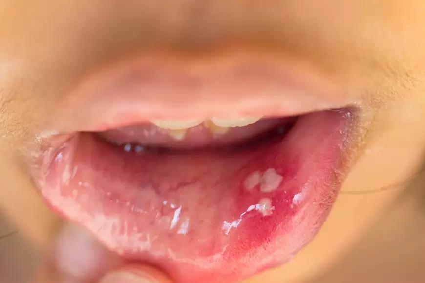 Mouth Ulcers:मुंह के छालों से है परेशान, तो अपनाएं ये घरेलू उपाय