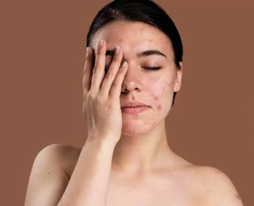 Pimples Treatment: गर्मियों में पिंपल्स की समस्या से है परेशान तो अपने किचन के इन चीजों से पाये उसका इलाज