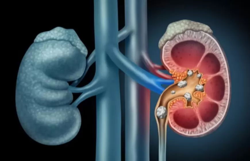 kidney stones: गुर्दे की पथरी को ठीक करने के कुछ घरेलू नुस्खे, लगातार इस्तेमाल से मिल सकता है आराम