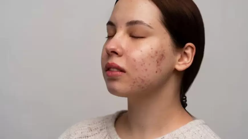 Acne Problems: बार बार हो रहे है पिंपल्स तो ये हो सकता है कारण !